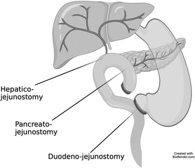 Case report: Pylorus-preserving pancreatoduodenectomy for focal congenital hyperinsulinism in a 5-month-old baby